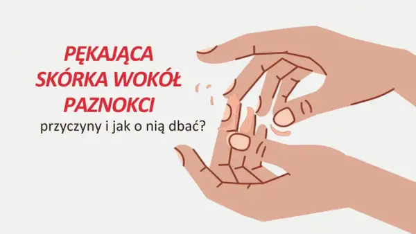 Pękająca skórka wokół paznokci. Ilustracja dłoni z suchymi, łuszczącymi się skórkami przy paznokciach.