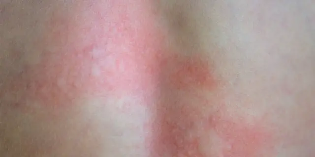 Czerwone, swędzące plamy na skórze, które zdają się przemieszczać, to objaw wędrującego świądu skóry.